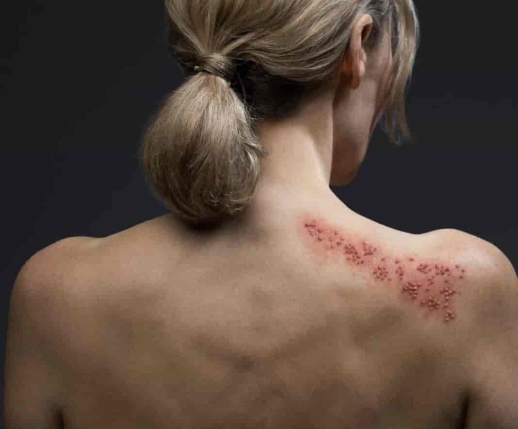 Έρπης ζωστήρας